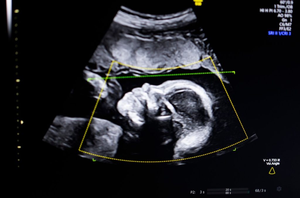 Biotics AI, Battlefield 2023, gains FDA approval for its AI-powered fetal ultrasound product 