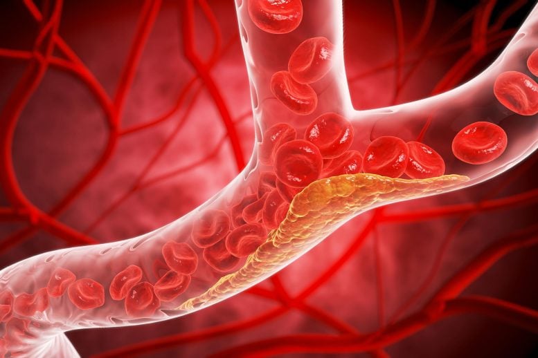 This Simple 48-Hour Diet Cut Harmful Cholesterol by 10%, Study Finds Narrowed Blood Vessel Cholesterol Plaque Buildup