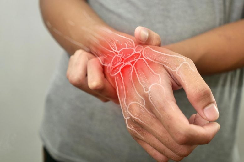 Scientists Discover How Psoriasis Turns Into Painful Joint Disease Rheumatoid Arthritis Wrist Joint Pain