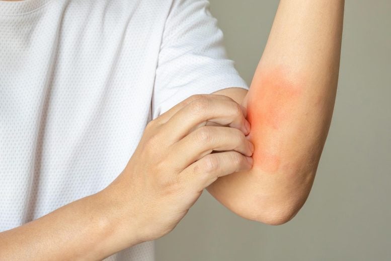 Your Skin Could Be Warning You About Mental Health Trouble Scratching Itchy Skin Rash