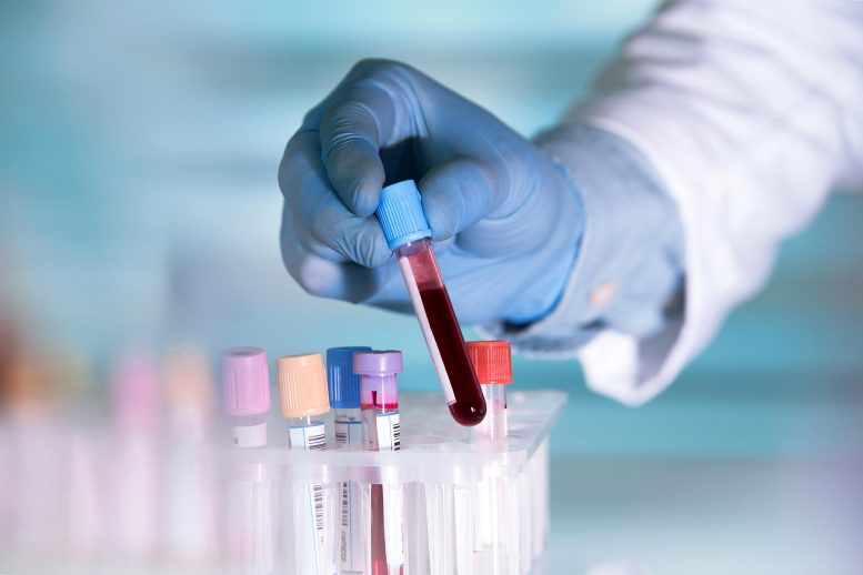 Scientists Find an Early Parkinson’s Signal Hidden in Blood Lab Technician Holding Blood Sample Test Tube